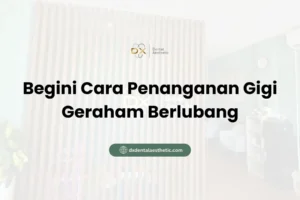 Begini Cara Penanganan Gigi Geraham Berlubang - DX Dental Aesthetic
