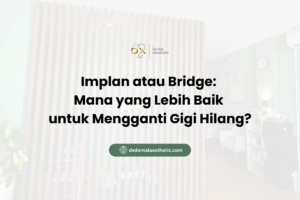 Implan atau Bridge: Mana yang Lebih Baik untuk Mengganti Gigi Hilang?