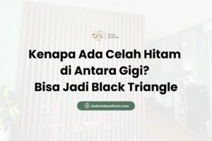 Kenapa Ada Celah Hitam di Antara Gigi? Bisa Jadi Black Triangle